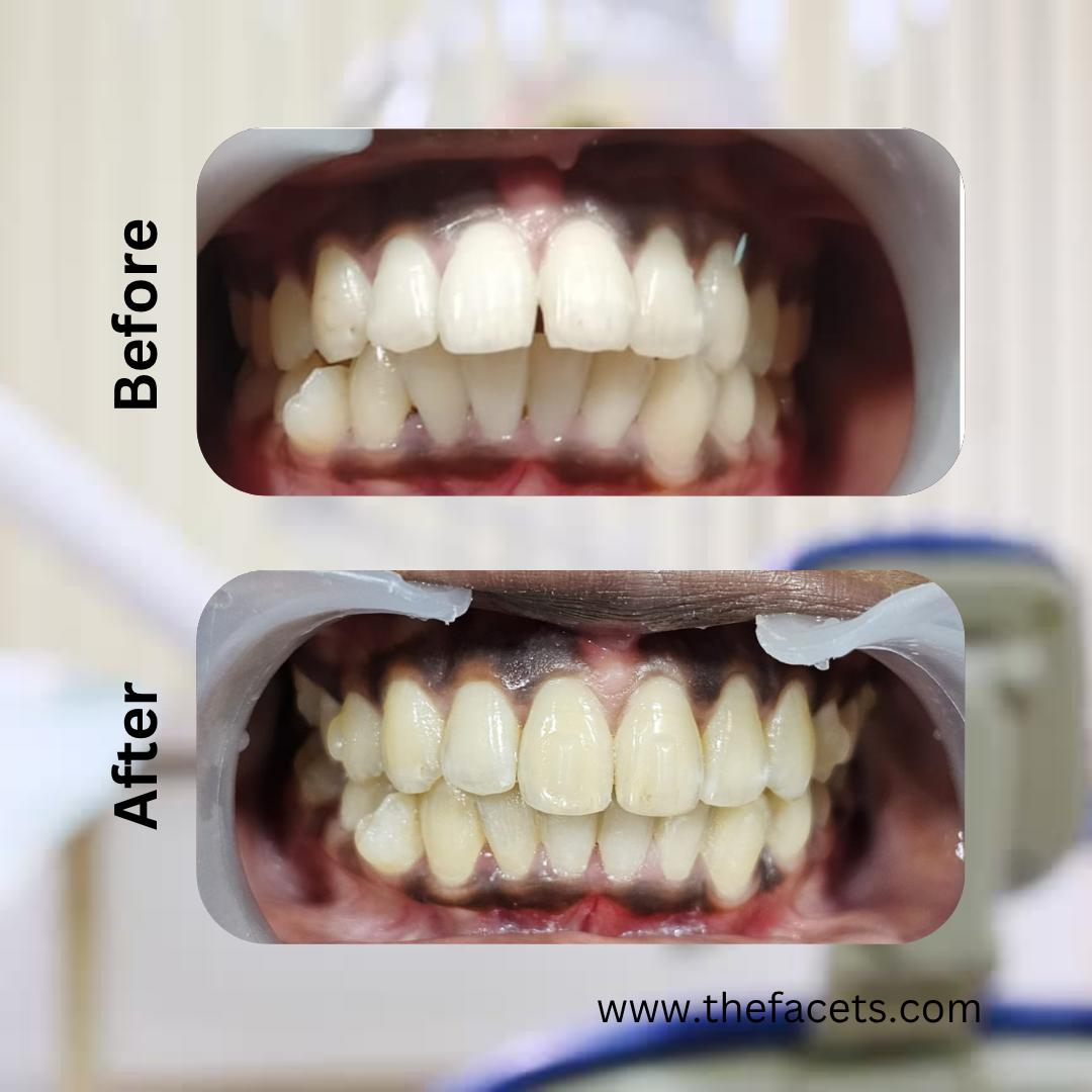 Before After Result 2